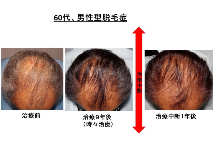 円形脱毛症　病院